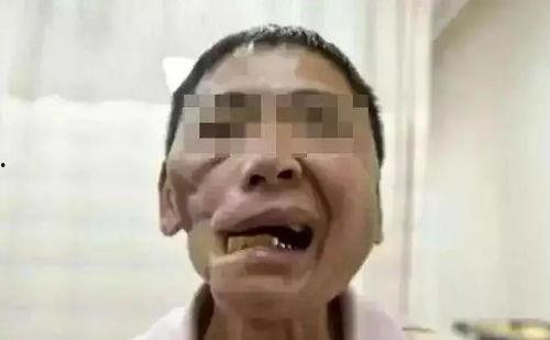 吃瓜下颚破皮视频下载,惊险瞬间！吃瓜下颚破皮视频引发网友热议